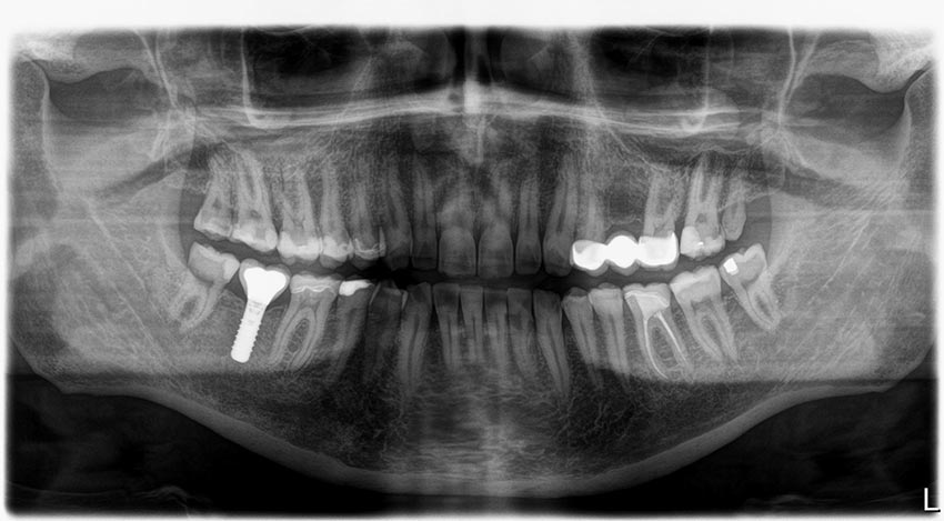 Χειρουργική τοποθέτηση οδοντικών εμφυτευμάτων